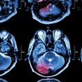 Simptomi tumora na mozgu
