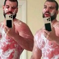 "Kog stepena su ove: Opekotine?" Adam Adaktar šokirao sve prepečenim telom - spušta pantalone i pokazuje razliku: "Sigurno vam…
