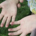 Počinju besplatni pregledi za atopijski dermatitis širom Srbije Svaki četvrti pacijent bez kontrole bolesti
