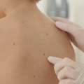 Ovčje boginje kod dece - kakvi su simptomi i na koji način se leče