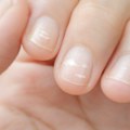 Bele mrlje na noktima mogu da budu simptom ozbiljnih bolesti