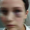 "Poderao mi je majicu, pa me udarao": Bolna ispovest devojke koju je pretukao poslodavac (foto)