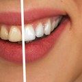 Doktor otkriva šta boja zuba govori o našem zdravlju