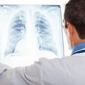 Srbija uvodi nove savremene terapije za rak pluća