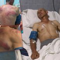 "Tražili mi pušku, a ja pušku nemam" Pretučeni Srbin Nenad iz Drena na Kosmetu o detaljima krvničkog prebijanja?! Pretili i…