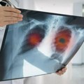 Pilula za rak pluća prepolovila rizik od umiranja: Lek je pozdravljen kao "promena prakse"