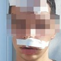 Dečaka pretukla grupa maloletnika u Belegišu: Gubio je svest, završio u bolnici, ušivali mu glavu i usnu