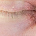 Znaci raka kože mimo mladeža: Dermatolog iz Londona opisao karakteristične kraste, mrlje, perut vredan pažnje