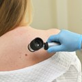 Dermatolog upozorava na jednu stvar, naročito tokom leta: "Odmah se javite lekaru" VIDEO