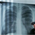 Preventiva je pola zdravlja u Somboru besplatan skrining pluća
