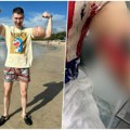 (Uznemirujuće) Poznatom influenseru preti amputacija ruku! Godinama ubrizgavao opasne supstance u bicepse kako bi izgledao…