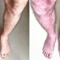 Sindrom plavih nogu: Otkriven novi simptom opasnog postkovida: Ugledni srpski kardiolog objašnjava šta znači ako vam noge…