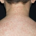 Epidemija malih boginja u Bugarskoj: Obolelo 446 ljudi, većina su deca