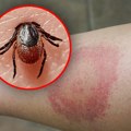 Muškarac je sam odmah uklonio krpelja, posle nedelju dana pao je u komu: Niz analiza je bilo potrebno da se njegovo stanje…