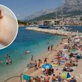 Jadranom hara bolest za koju smo mislili da je izumrla: Impetigo izaziva rane koje pucaju, najviše napada decu