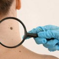 U KBC Zvezdara od 68 dermatoloških pregleda, otkriveno 6 sumnjivih promena na koži