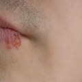 Virus herpesa može da poremeti odbrambeni sistem mozga, pokazuje novo istraživanje