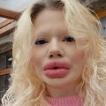 Žena sa najvećim usnama na svetu otkrila kako je nekada izgledala: Šta kažete na ovu razliku?
