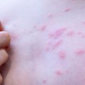 Crvene kvržice nakon boravka na plaži: Prva i zabrinjavajuća reakcija tela na ujed peščanih buba