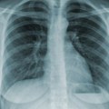 Besplatan skrining za rano otkrivanje raka pluća