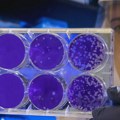 "Bolest napreduje, svaki mesec je važan": Više od 200 obolelih čeka lek za cističnu fibrozu (VIDEO)