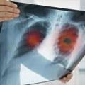 Skrining raka pluća pred vratima Srbije: Lekari viđaju veliki broj ogromnih tumora, takvih treba da bude manje