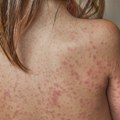 Srbija: Skoro 200 slučajeva malih boginja od početka godine