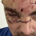 Uznemirujuće: Ovako izgledaju jezive povrede koje je Karlik DŽons naneo mladiću flašom (foto)