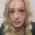 "Celo lice mi je krvavo, a nos slomljen": Beograđanku i njenog muža brutalno prebili radnici obezbeđenja u kafani: "20 ljudi…