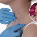 U Srbiji otkrivena 22 melanoma i 253 sumnjive promene: Lekari apeluju da pregledate kožu, ne treba vam uput