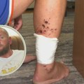 "Ноге су ми црне и пробија крв": Саша на протесту добио повреде и опекотине од експлозивне направе