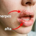 Afte ili herpes: Kako prepoznati ključne razlike i ubrzati lečenje