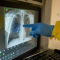 U Srbiji svake godine od raka pluća oboli oko 7.000 ljudi uprkos organizovanom skriningu