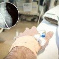 Pacijent u Beogradu završio u bolnici jer je progutao viljušku! Doktor objavio sliku: "Volim svoj posao!" (foto)