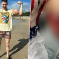 (Uznemirujuće) Poznatom influenseru preti amputacija ruku! Godinama ubrizgavao opasne supstance u bicepse kako bi izgledao…