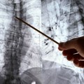 Muškarac živeo 8 godina sa nožem u grudima: Lekari ostali u čudu kad su saznali jedan detalj