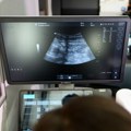 Ova "tempirana bomba" ozbiljan je zdravstveni problem: Skrining abdominalne aortne aneurizme spasava život