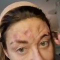 Evo šta se krije iza uništenog lica Ane Nikolić! Pevačica puna ožiljaka i živih rana: "Uznemireno je dozivala doktora"
