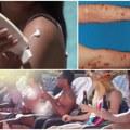 Alergija na sunce pogađa sve više ljudi Ovo su koraci koje bi trebalo da preduzmete pred odlazak na letovanje evo kako da se…