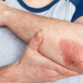Udruženje obolelih od psorijaze: Biološka terapija dostupna svima koji ispunjavaju uslove