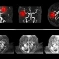 Naučnici napravili male nanorobote za lečenje aneurizme mozga