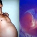 Godinama mu je rastao stomak, a lekari su su njegovom telu našli fetus: Više od 30 godina živeo je sa ta tim u stomaku, a…