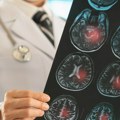 Kako prepoznati lakunarni moždani udar na vreme i spasiti život: Svaki sekund je presudan