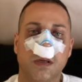 Lice u modricama Marko Đedović pokazao kako izgleda nakon operacije nosa (foto)