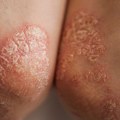 FDA odobrila prvu dnevnu tabletu za umerenu do tešku psorijazu: Očistila kožu kod 70 odsto pacijenata
