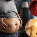 Gojaznost i nedostatak vitamina D su smrtonosna kombinacija