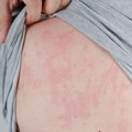 Šapčanin objavio slike ujeda po celom licu i telu, pa zavapio: Ljudi, pomozite, ovo je neizdrživo!